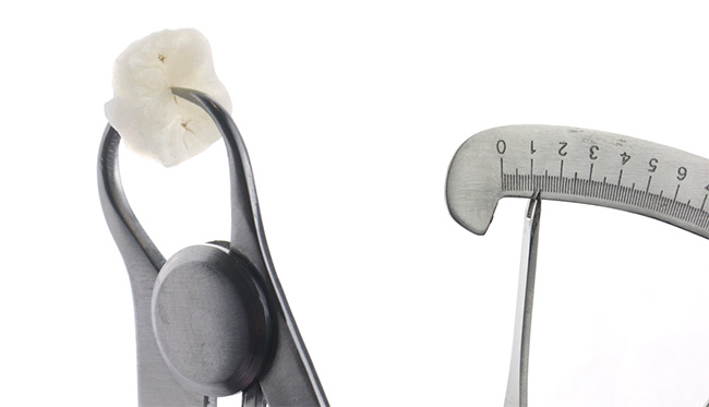 Fig 7 : Contrôle de l’épaisseur des restaurations overlays 