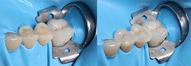 Fig 8 : Collage des Overlays (Variolink LC Ivoclar Vivadent)