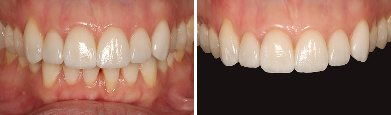 Article-Ruben-Abou-Resultat-1-an-post-op