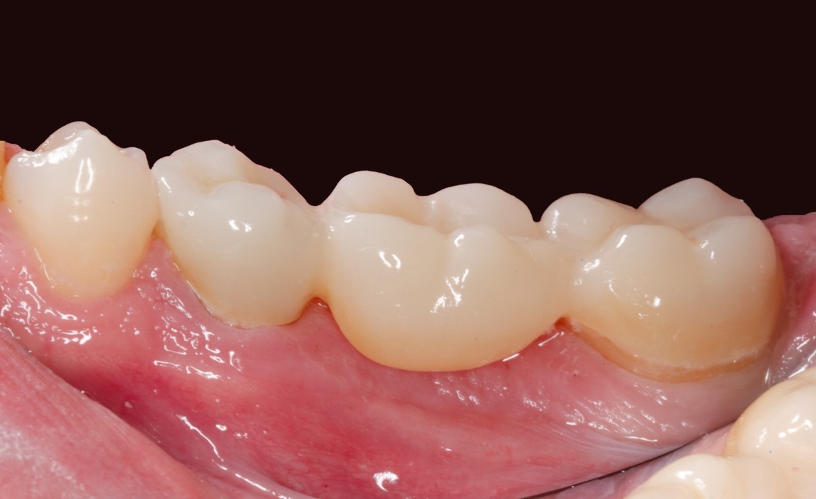 Bridge vue immédiate après scellement