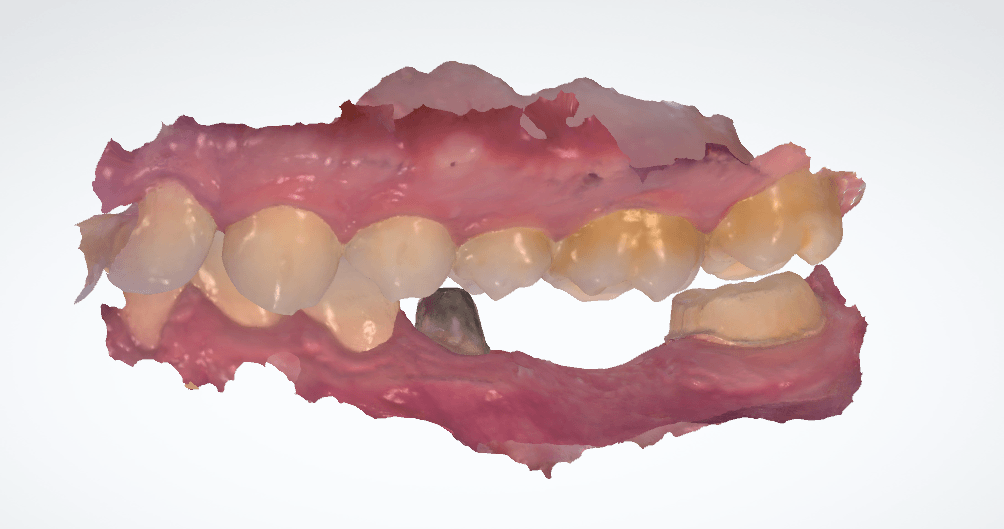 Modélisation de la restauration sur le logiciel 3Shape Dental System