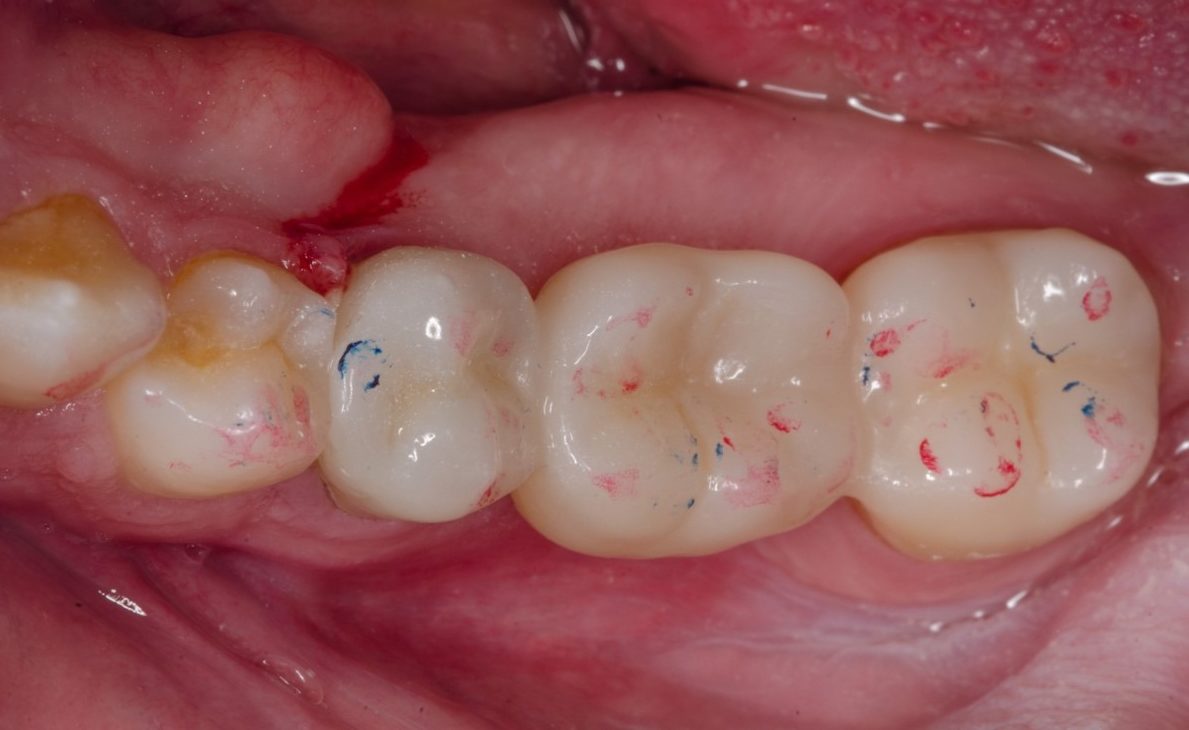 Contrôle de l’occlusion