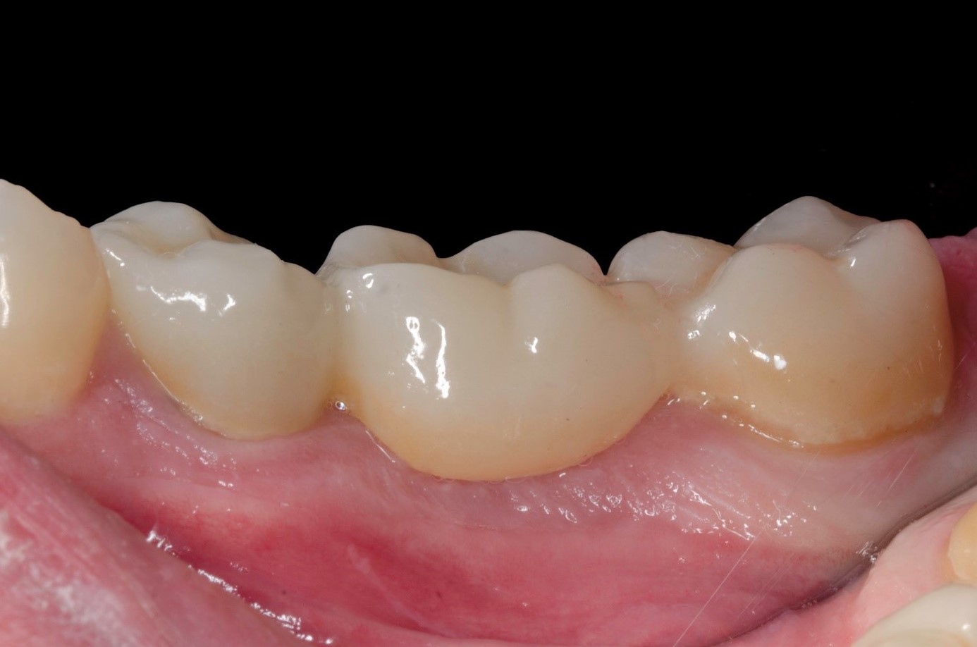 Contrôle à 1 mois, vue vestibulaire