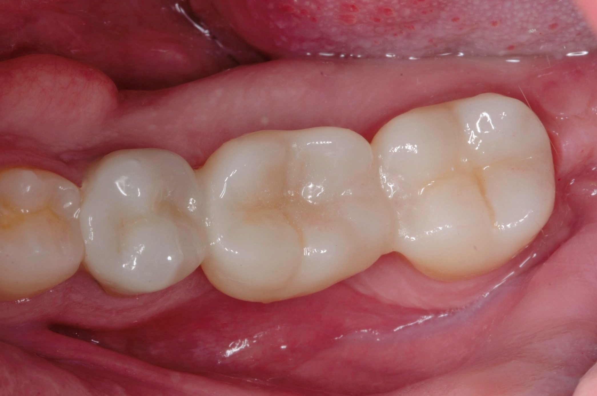 Contrôle à 1 mois, vue occlusale