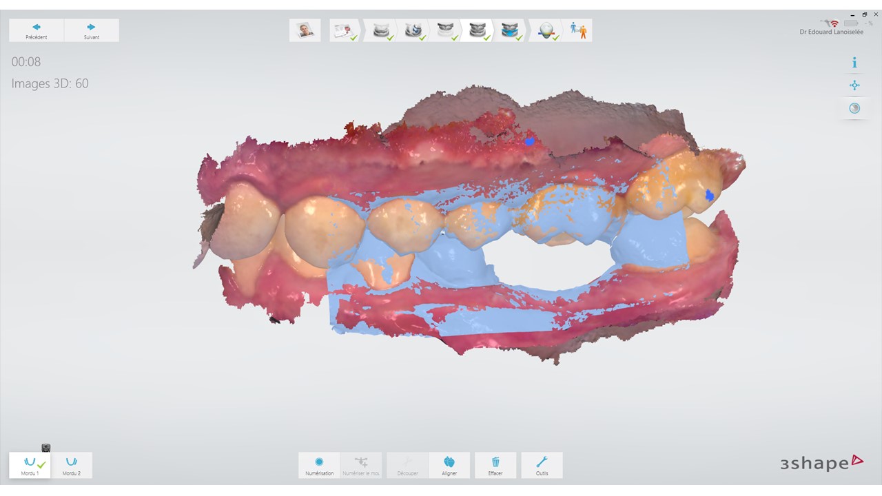 Enregistrement de l’occlusion statique