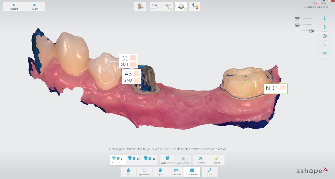Relevé de la couleur et limites prothétiques