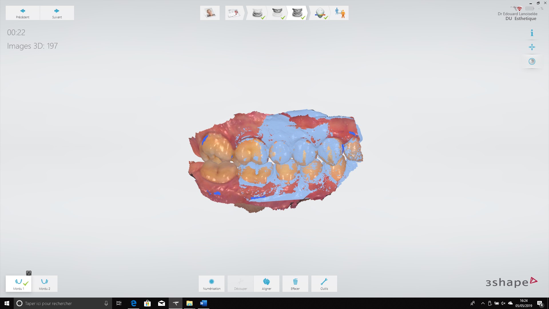 empreinte - enregistrement en occlusion statique