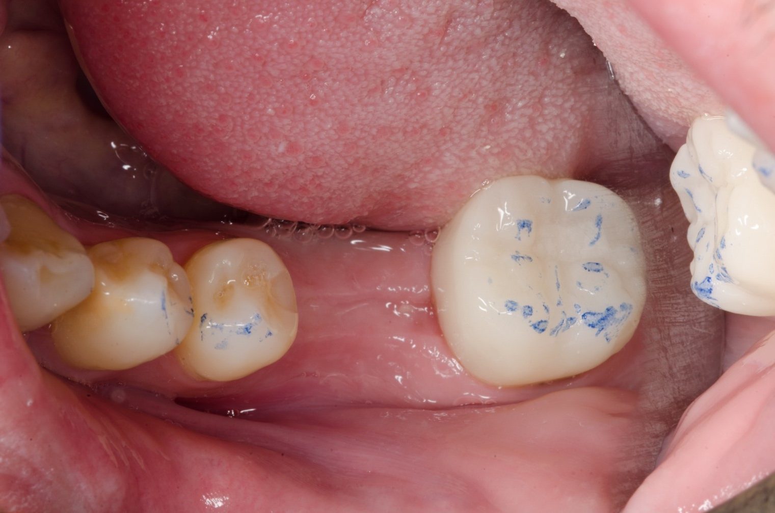 Essayage de la couronne provisoire