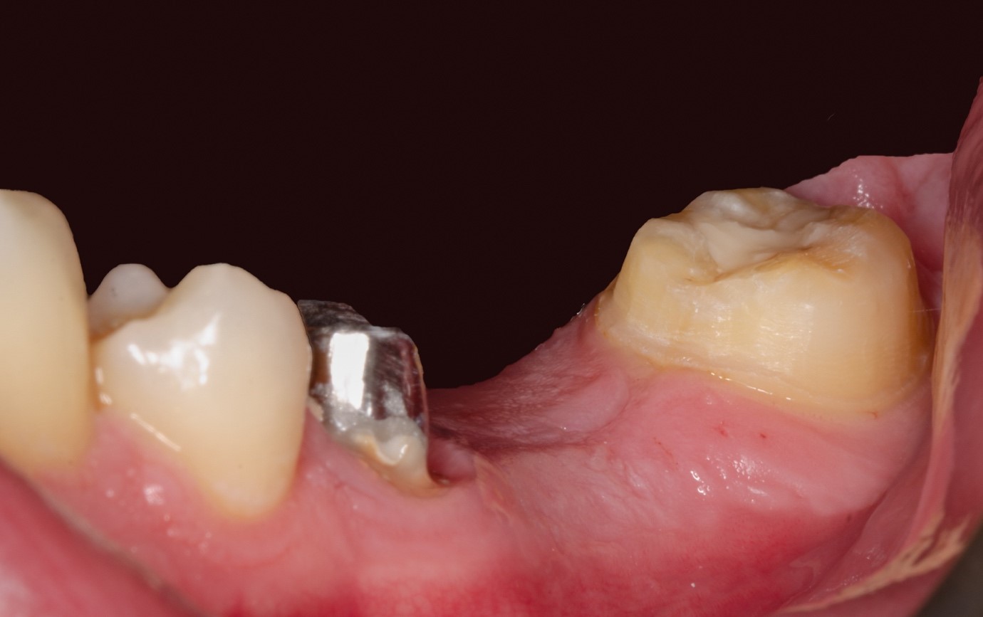 Les dents préparées