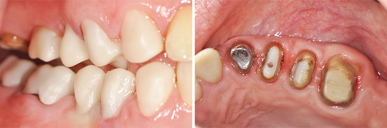 Fig. 10c : Restauration des secteurs postérieurs droits. Contrôle de l’espace prothétique. Fig. 10d : Restauration du secteur maxillaire gauche. Détail des préparations.