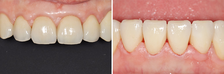 Fig. 11a et 11b : Restaurations céramo-céramiques antérieures en place.