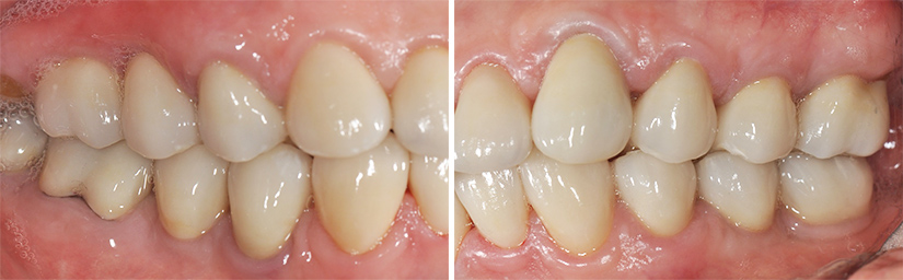 Fig. 11f : Restaurations postérieures droites, vue latérale en OIM. Fig. 11g : Restaurations postérieures gauches, vue latérale en OIM.