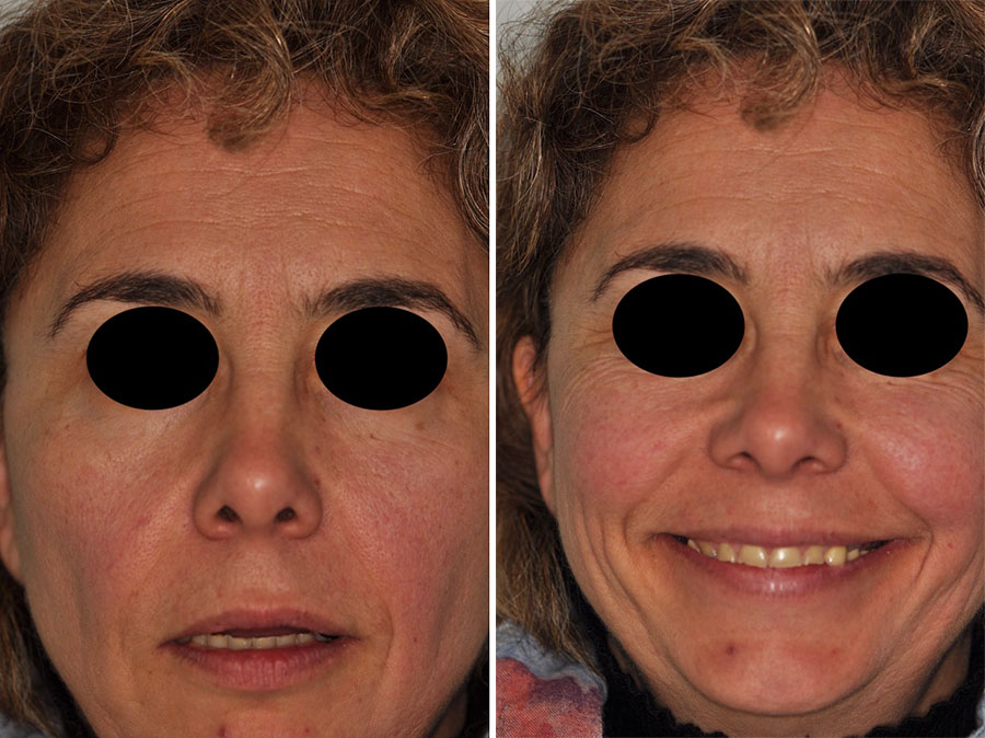 Fig. 1a : Visage de la patiente, lèvres au repos. Fig. 1b : Visage de la patiente lors du sourire maximal.