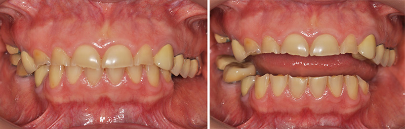 Fig. 2a : Vue intra-buccale frontale en occlusion de convenance. Fig. 2b : Vue intra-buccale frontale en incocclusion.