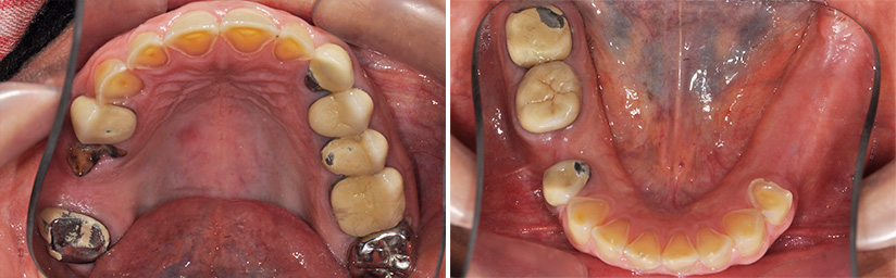 Fig. 2c : Vue occlusale de l’arcade maxillaire. Fig. 2d : Vue occlusale de l’arcade mandibulaire.