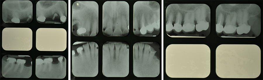 Fig. 3b à 3d : bilan rétro-alvéolaire initial.