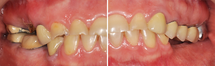 Fig. 5a : Vue intra-buccale latérale droite en occlusion de convenance. Fig. 5b : Vue intra-buccale latérale gauche en occlusion de convenance.