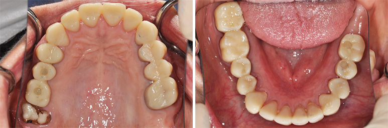 Fig. 9a : Restaurations transitoires en place, vue occlusale maxillaire. Fig. 9b : Restaurations transitoires en place, vue occlusale mandibulaire.