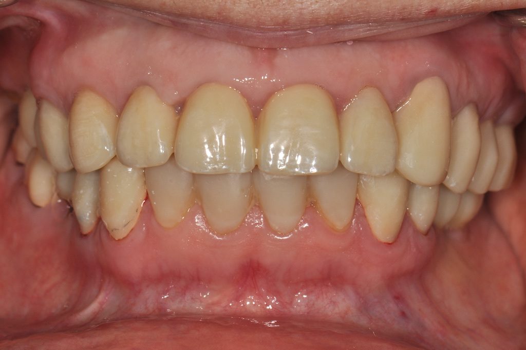 Fig. 9c : Restaurations transitoires en place, vue frontale en OIM.