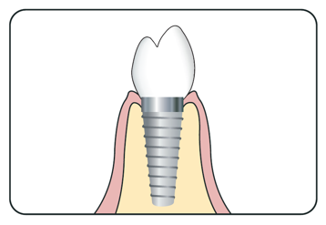 Entretien des implants – Les fondamentaux pour prévenir les maladies péri-implantaires