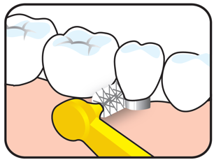 Entretien des implants – Les fondamentaux pour prévenir les maladies péri-implantaires