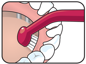 Entretien des implants – Les fondamentaux pour prévenir les maladies péri-implantaires