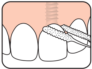 Entretien des implants – Les fondamentaux pour prévenir les maladies péri-implantaires