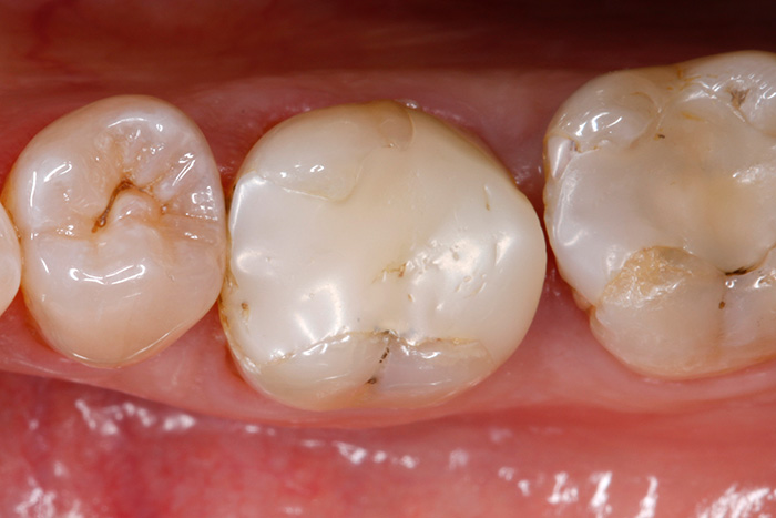 III 1 : Situation de départ : obturation composite médiocre dans la dent 46 (photo prise sur miroir intra-buccal).