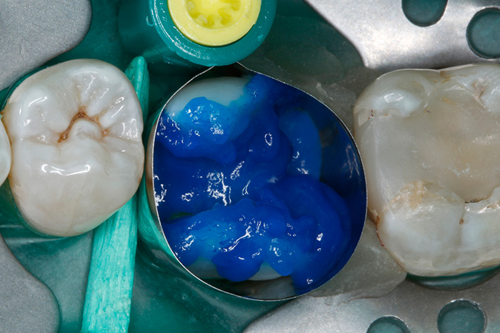 Ill. 5 : Conditionnement de la substance dentaire dure avec un gel d'acide phosphorique à 35 %.