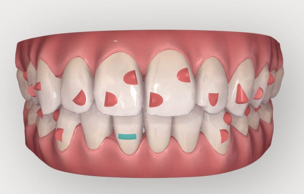 Situation finale Clincheck initial