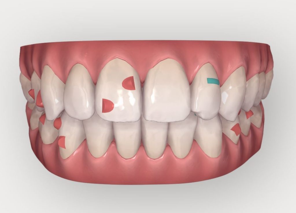 Fin du second Clincheck