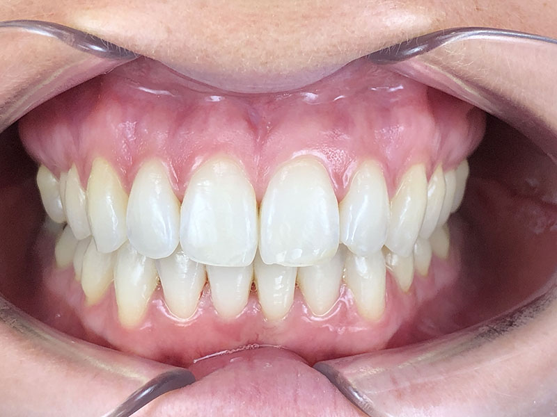 Traitement terminé avec blanchiment