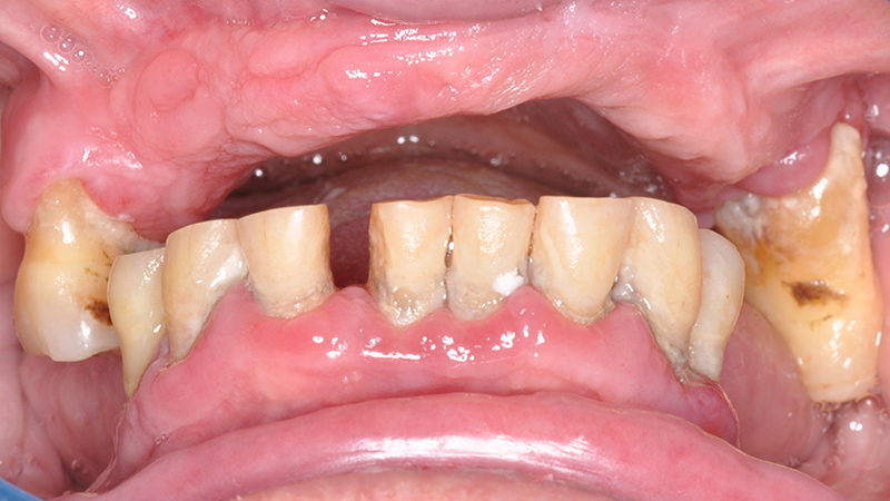 Perte de dimension verticale