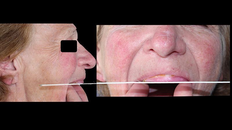 Utilisation la plaque de Fox