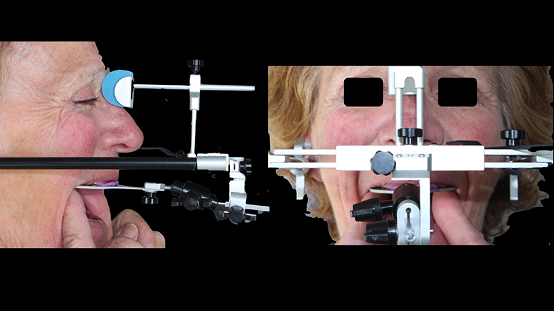 Prise d'un arc facial