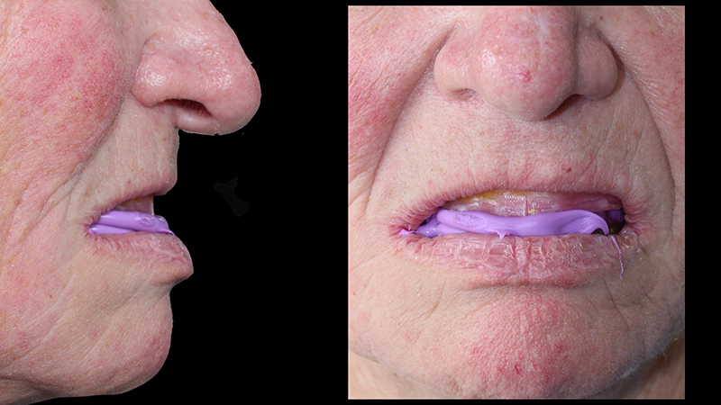 Utilisation d'un silicone d'occlusion