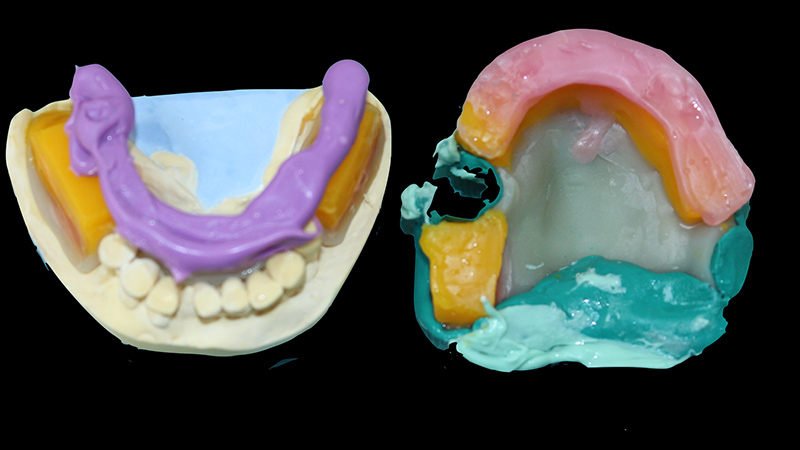 Cire d’occlusion mandibulaire
