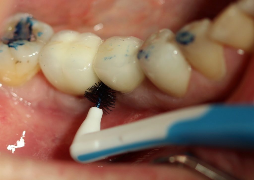 Fig. 3 : Le contrôle de plaque n'est pas réalisé en lingual chez ce même patient
