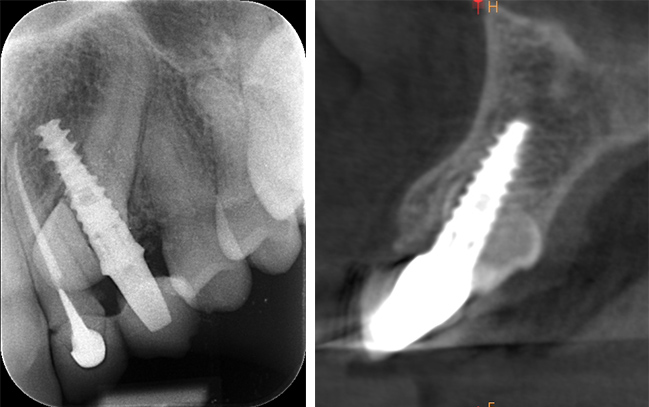 Scanner à la pose de la couronne sur implant
