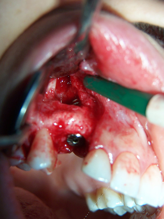 La canine incluse est extraite, mise en place d’un implant Aphabio SPI 3.75/13 mm