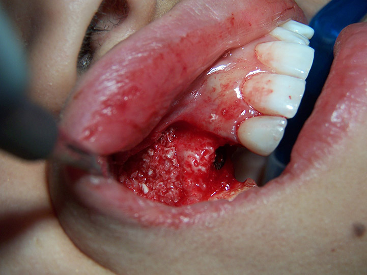 Le défaut osseux péri implantaire est favorable à l’utilisation du matériau de comblement (Bio-Oss).