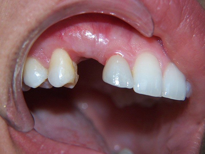 Cicatrisation 15 jours post opératoires