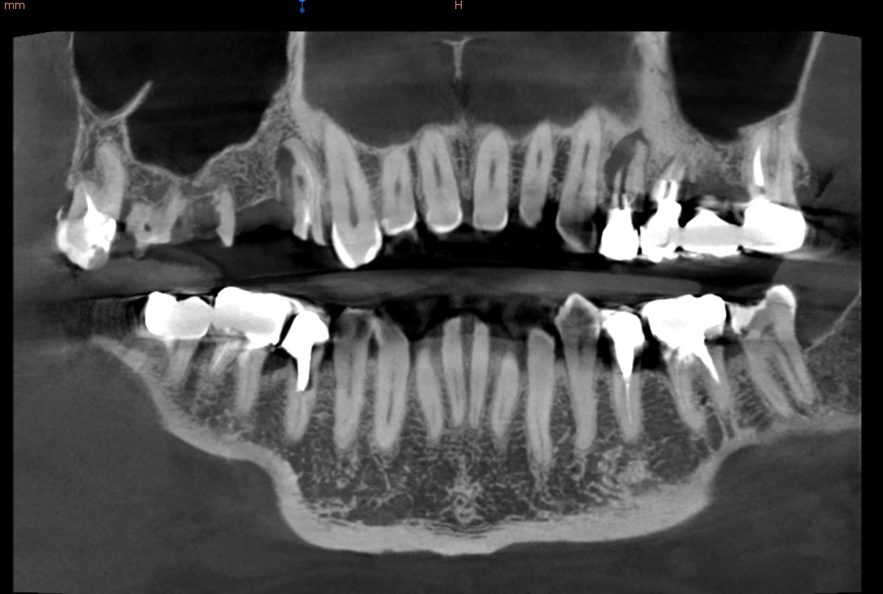 Analyse du scanner pré opératoire.