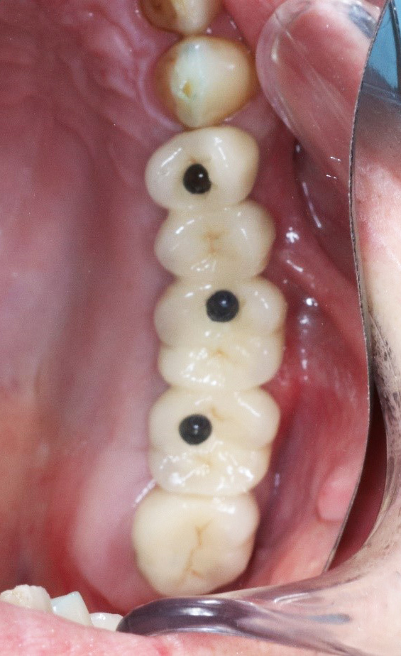 Fig. 17 : Pose des couronnes définitives transvissées.