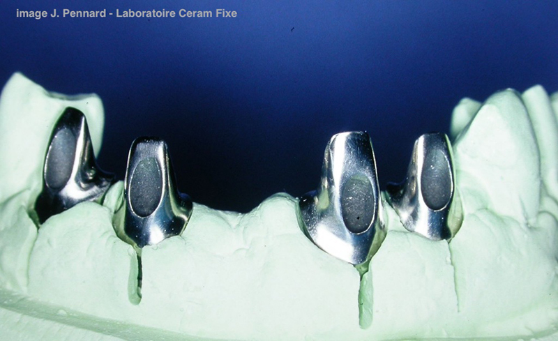 LA CORRECTION DE L’AXE IMPLANTAIRE