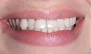 Sourire patiente 30 ans