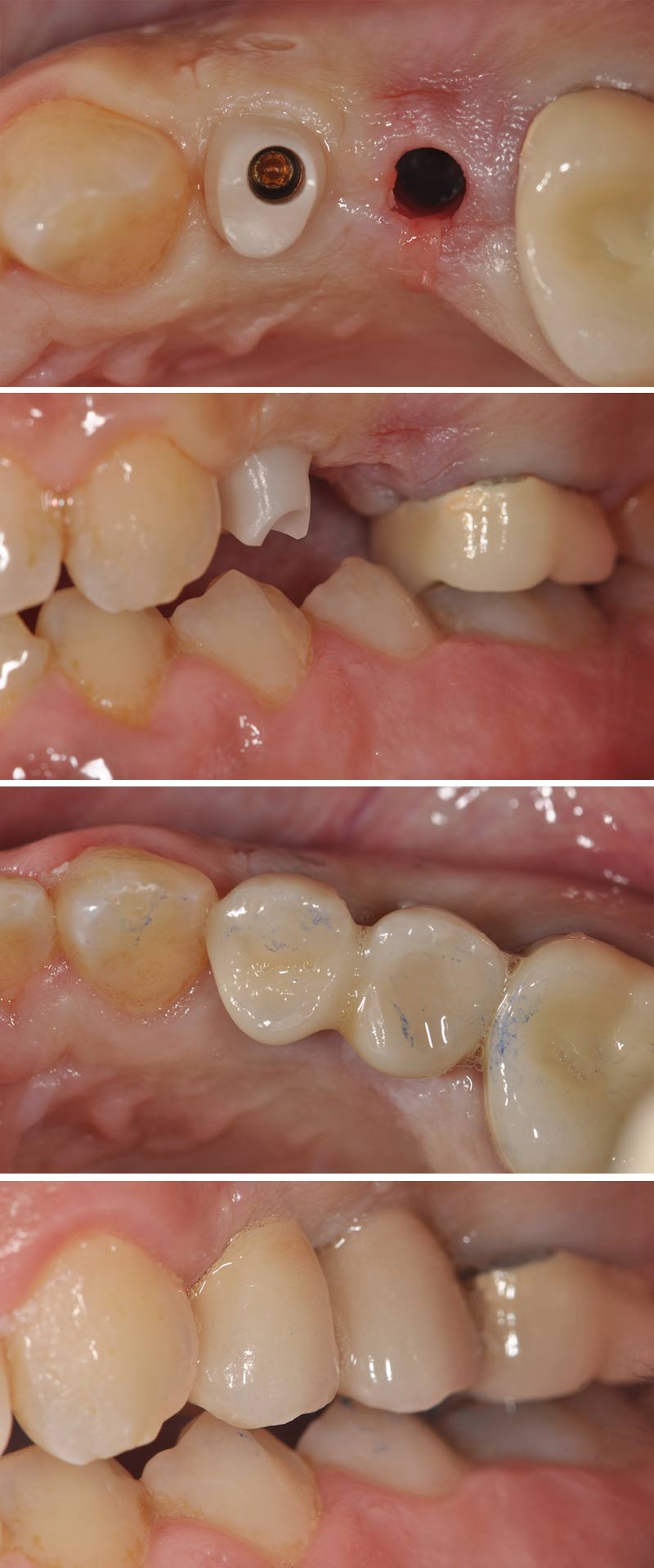 Résultat prothétique final