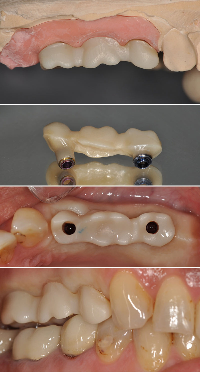 option du transvissage