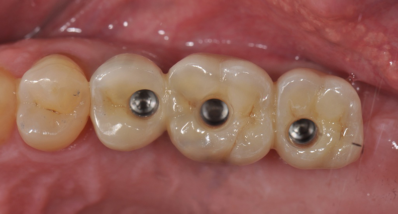 LE RÉSISTANCE DE LA CÉRAMIQUE