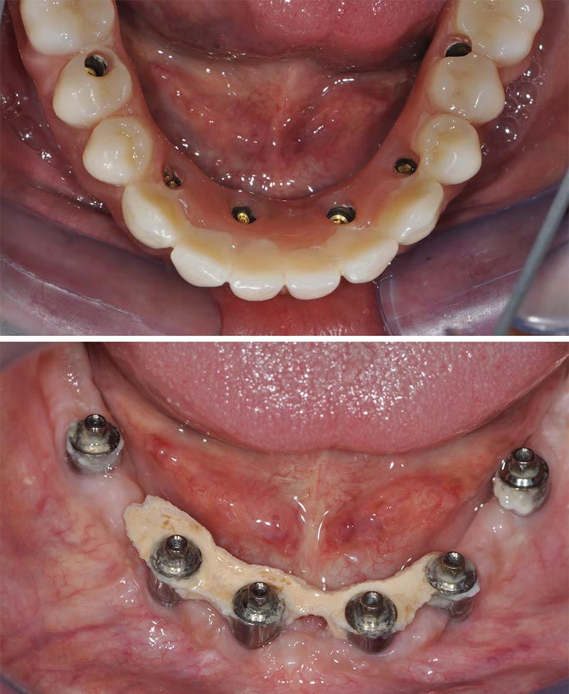 La conception vissée